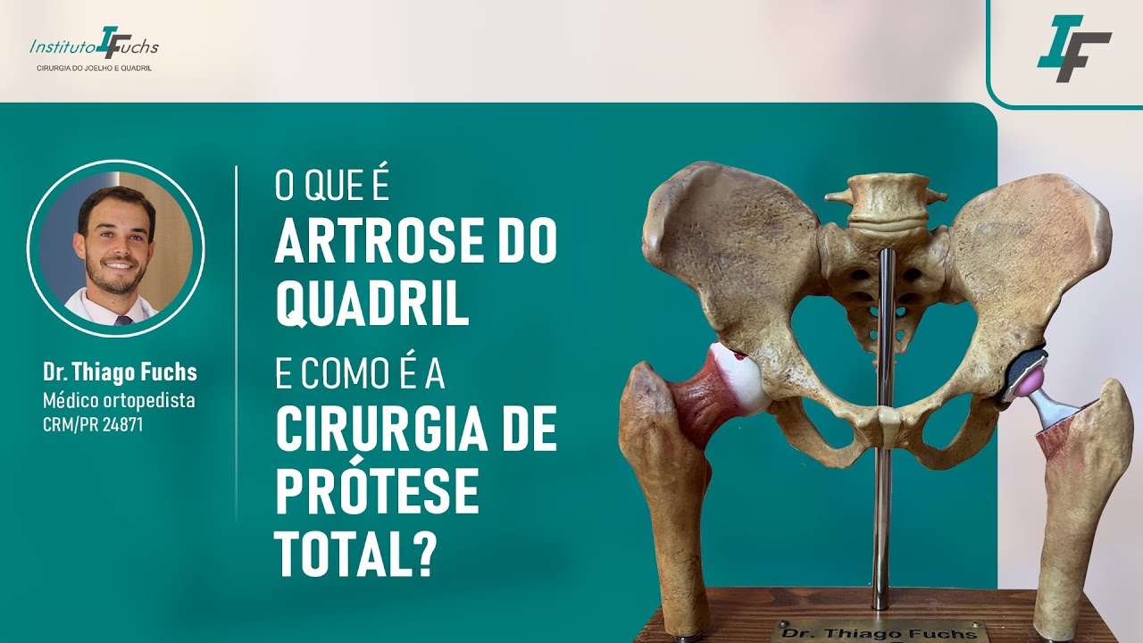 O que é ARTROSE DO QUADRIL e como é a CIRURGIA de PRÓTESE TOTAL DO QUADRIL