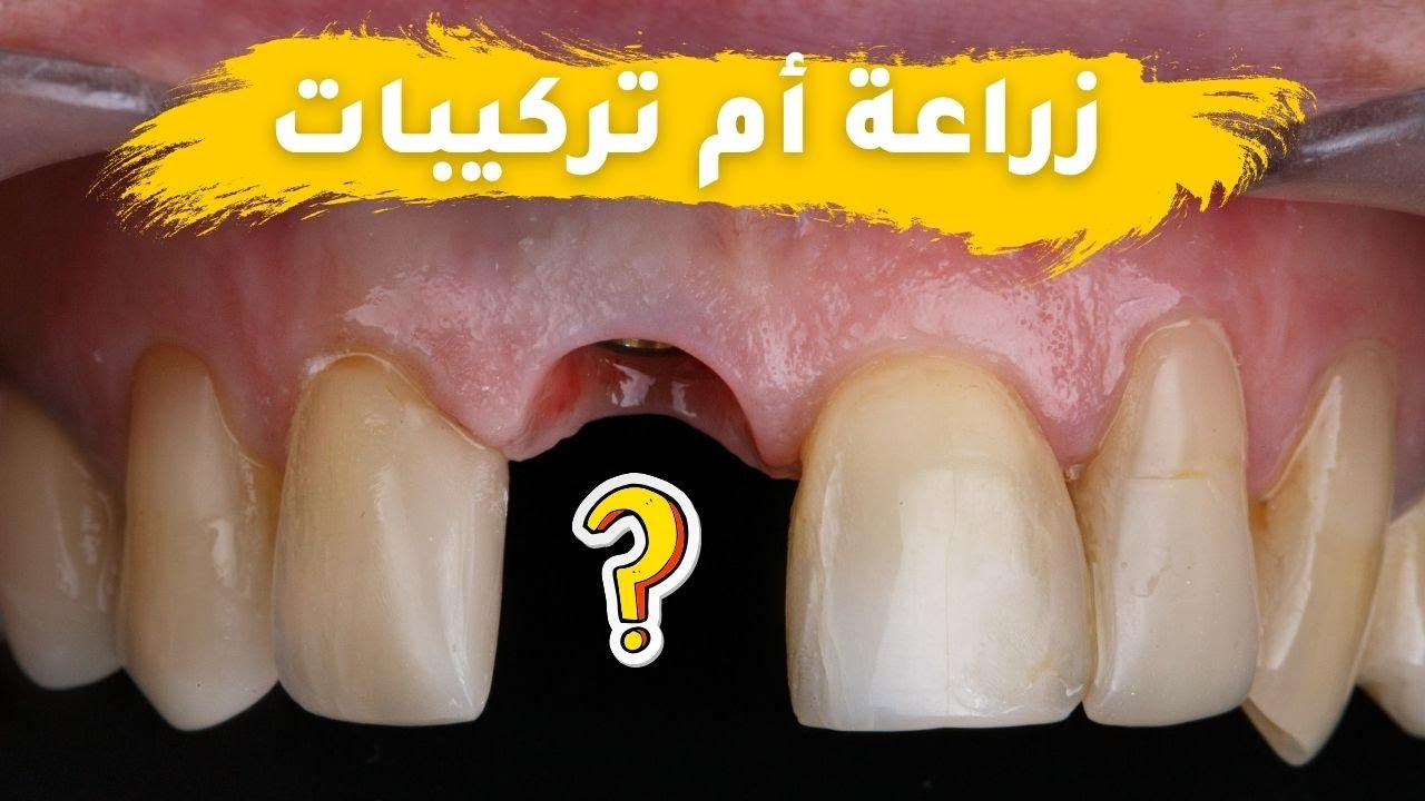 زراعة الأسنان vs تركيبات الأسنان: أيهما أفضل ؟