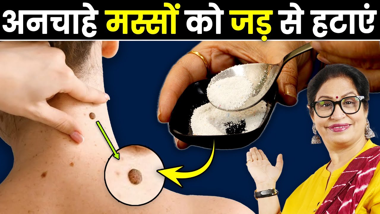 चेहरे और गर्दन के मस्सों को जड़ से खत्म करें, इस घरेलू नुस्खे से बिना दाग छोड़े Moles & Warts Removal