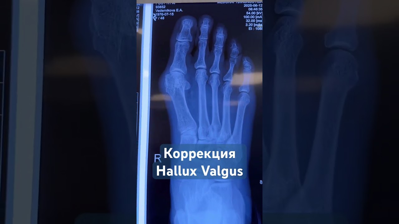 Коррекция деформации стопы Hallux Valgus | от доктора Нефедьева #halluxvalgus