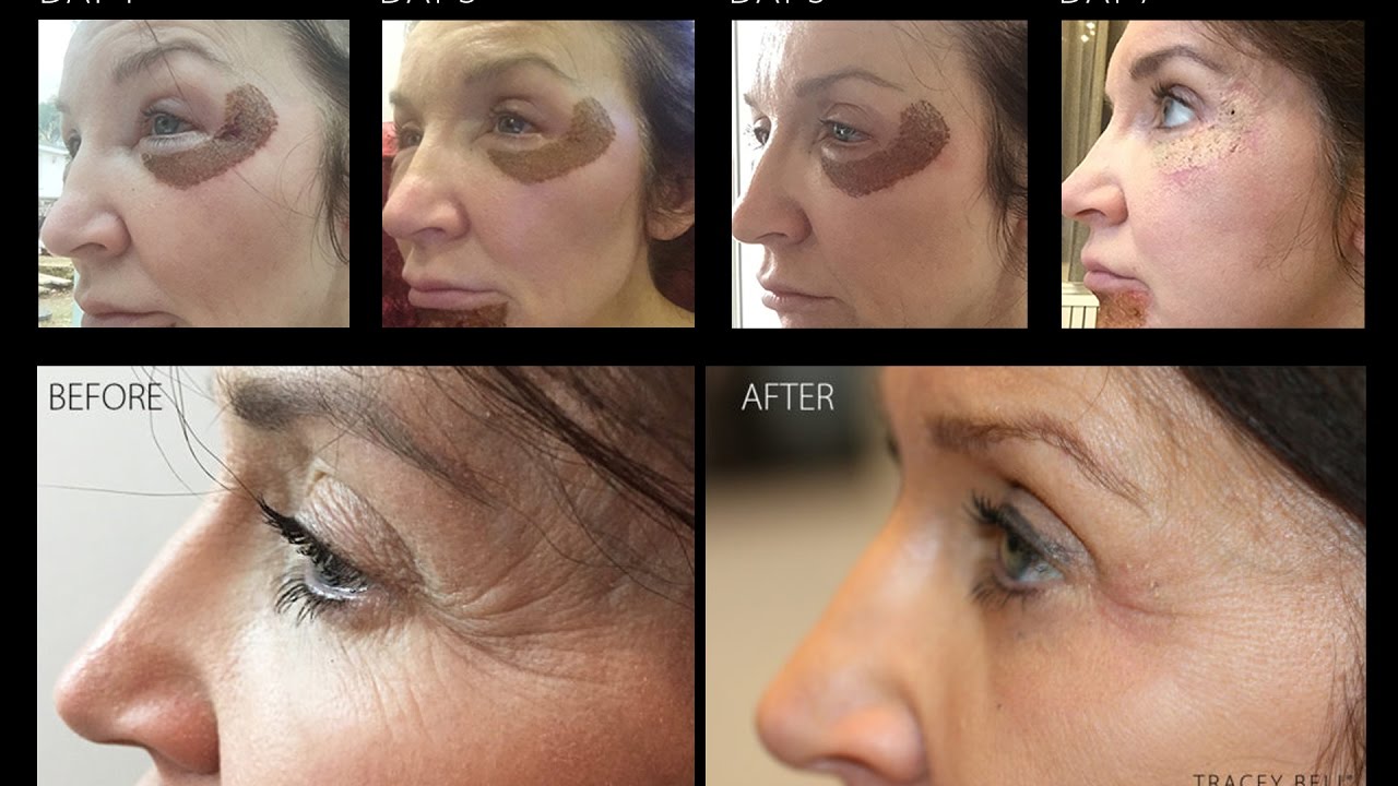 Plexr - before and afters  - real results