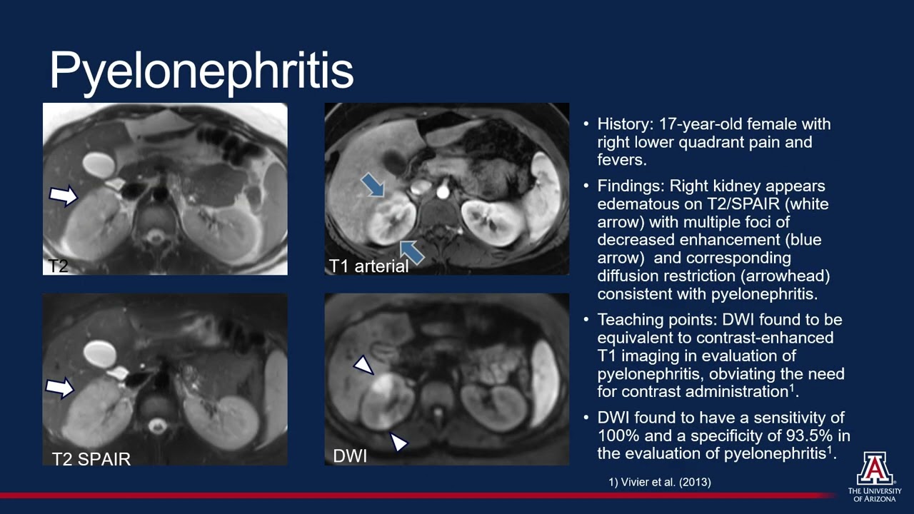 Diffusion Abnormalities in the Pediatric Patient with Acute Abdominal Pain
