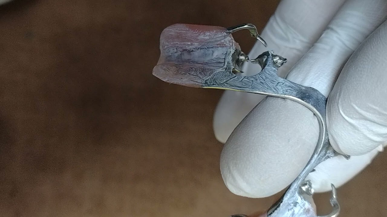 【金属床セット時のチェック】　実際に物を噛んで頂き、歯肉へのあたりをチェック。装着感と脱着のスムーズさを確認します。違和感、異物感の少なさと発音のしやすさは金属床の最大のメリットと思われます。