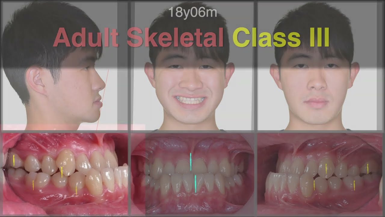 Adult Class III, OJ = -5mm｜【Chris Chang Ortho】CC658