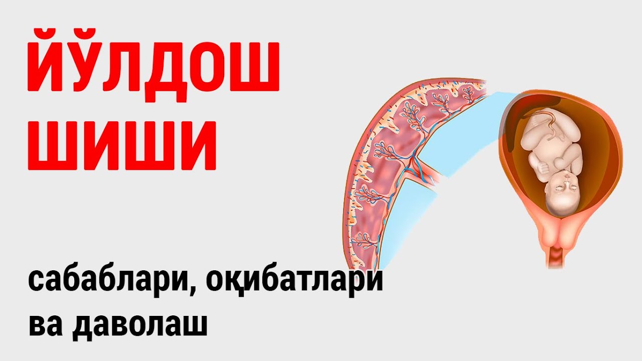 Йўлдош шиши: сабаблари, оқибатлари ва даволаш