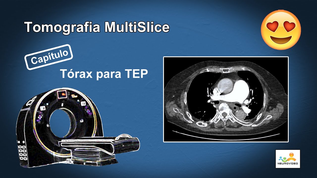 Tomografia Angio de Artérias Pulmonares (TEP)
