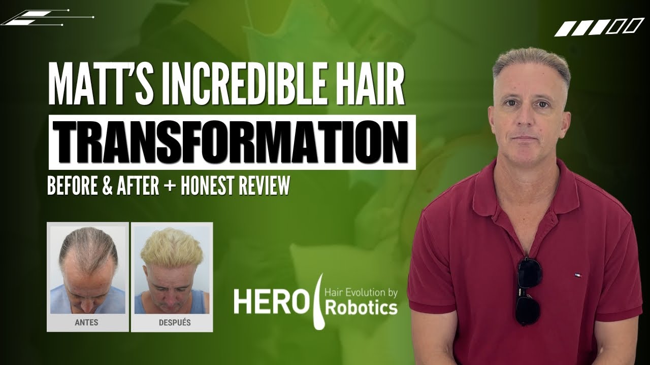 Matt’s Incredible Hair Transformation | Before & After + Honest Review