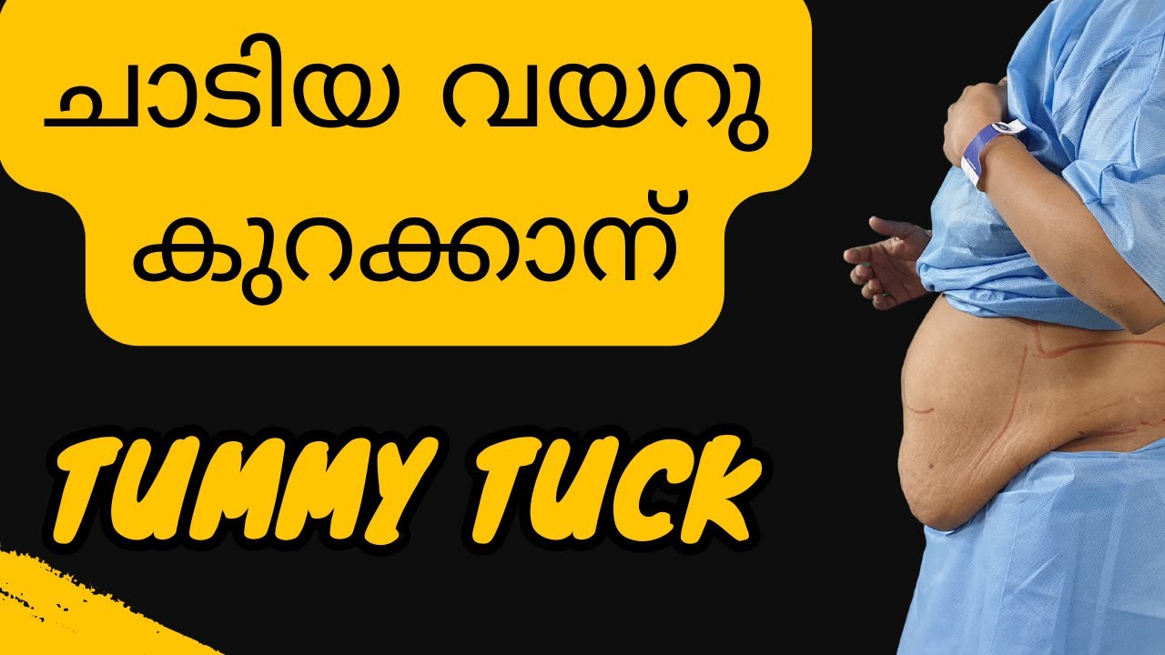 Tummy Tuck surgery (Abdominoplasty) in Kerala || Belly Fat Removal Surgery || Thrissur