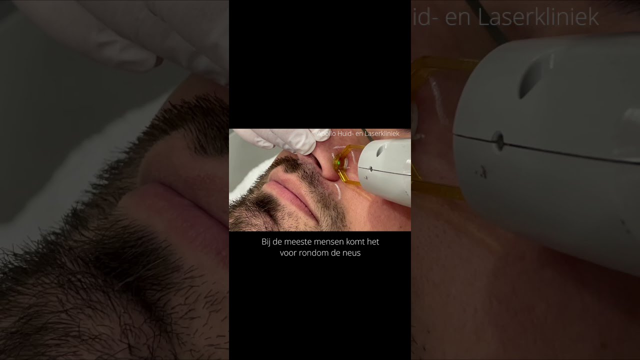 Laserbehandeling tegen Couperose en bloedvaatjes op het gezicht.