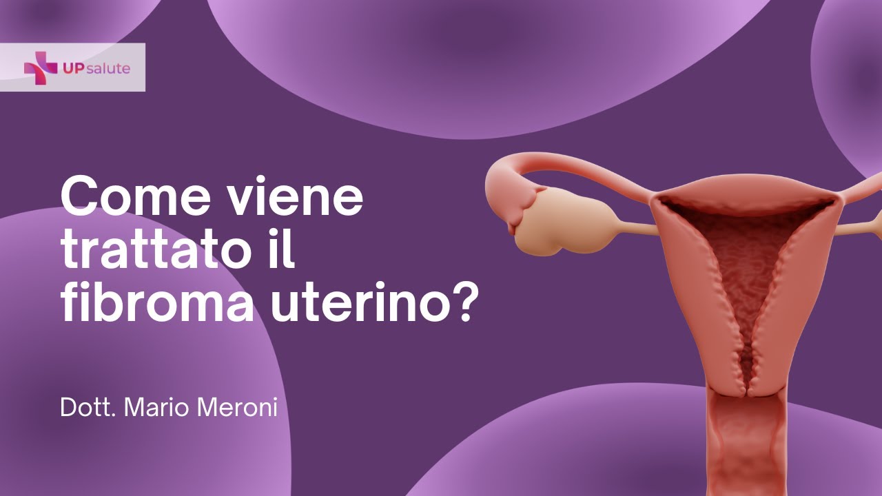 Come viene trattato il fibroma uterino? - Dott. Mario Meroni - UPsalute Channel