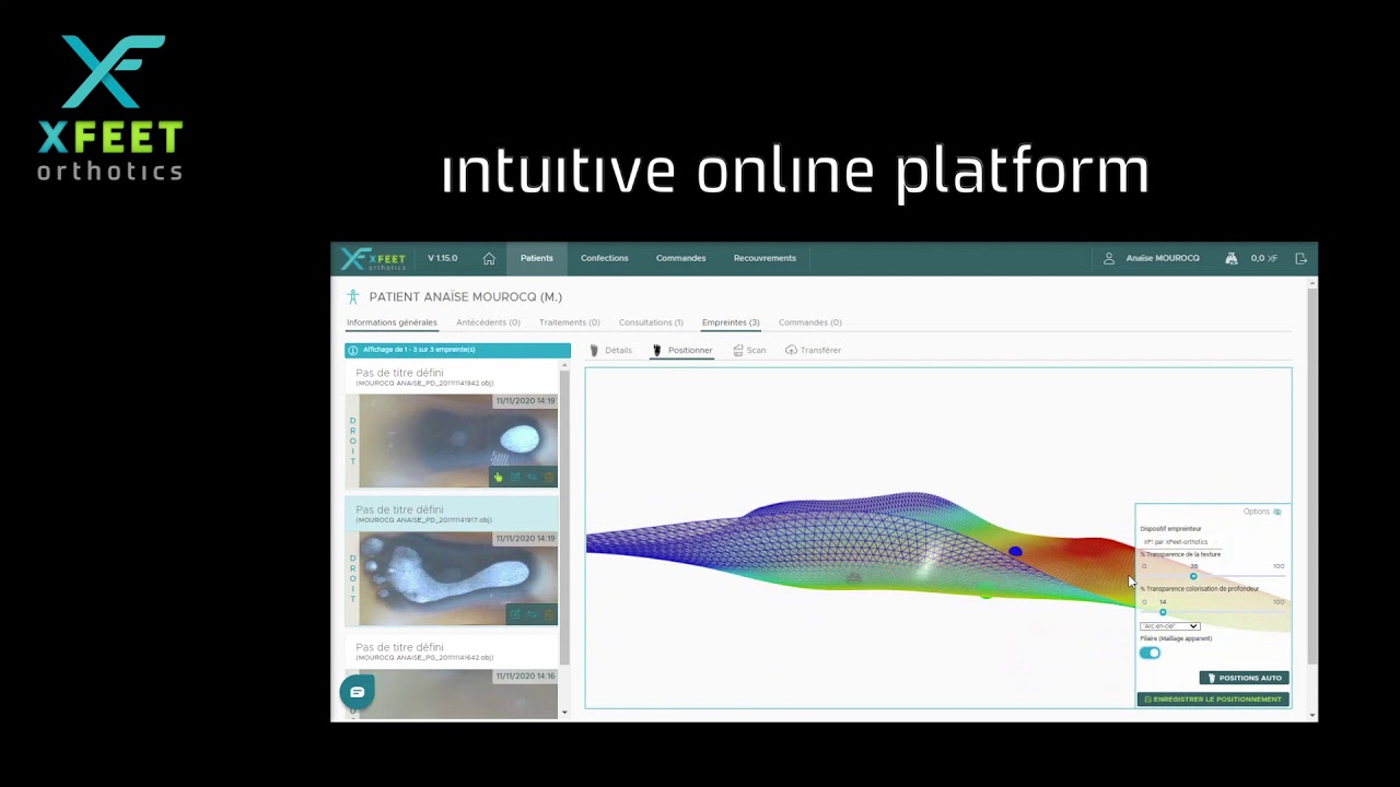 XFeet - digital revolution in podiatry : 3d printed orthopedic insoles