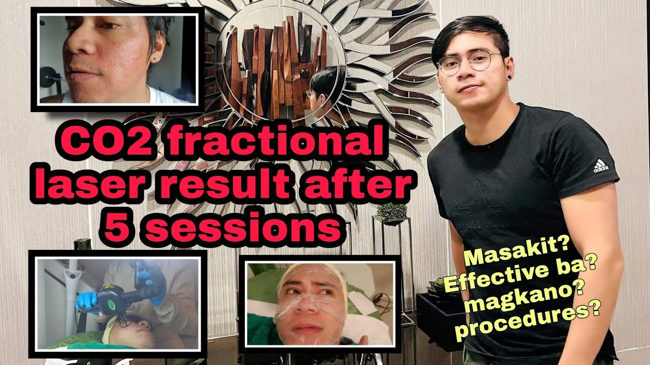 C02 Fractional Laser Result after 5 Sessions (Regenix)