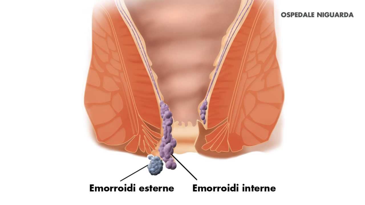 Emorroidectomia