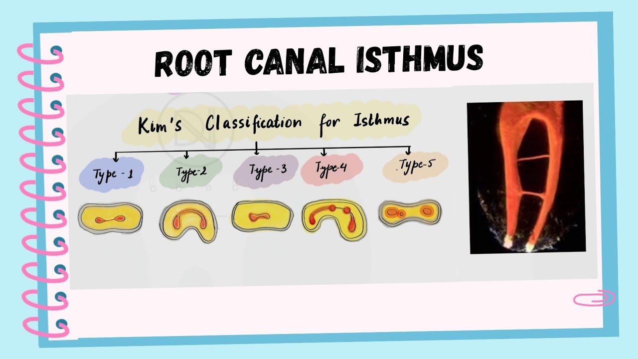 Root Canal Isthmus: A Hidden Cause of Endodontic Failure
