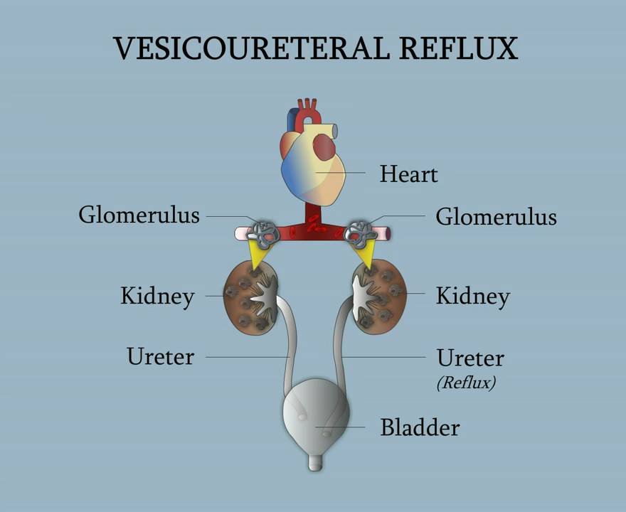 Vesicoureteral Reflux
