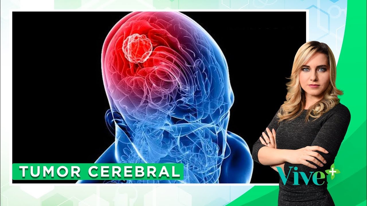 Tumor cerebral: ¿cómo detectarlo? | Vive Más - #ConsultorioEnLínea