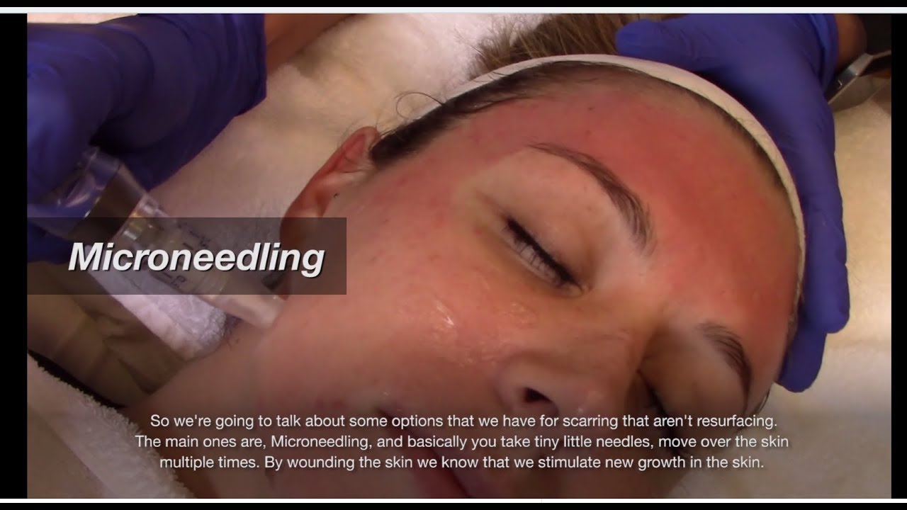 Scarring Treatment Solutions at Advanced Dermatology