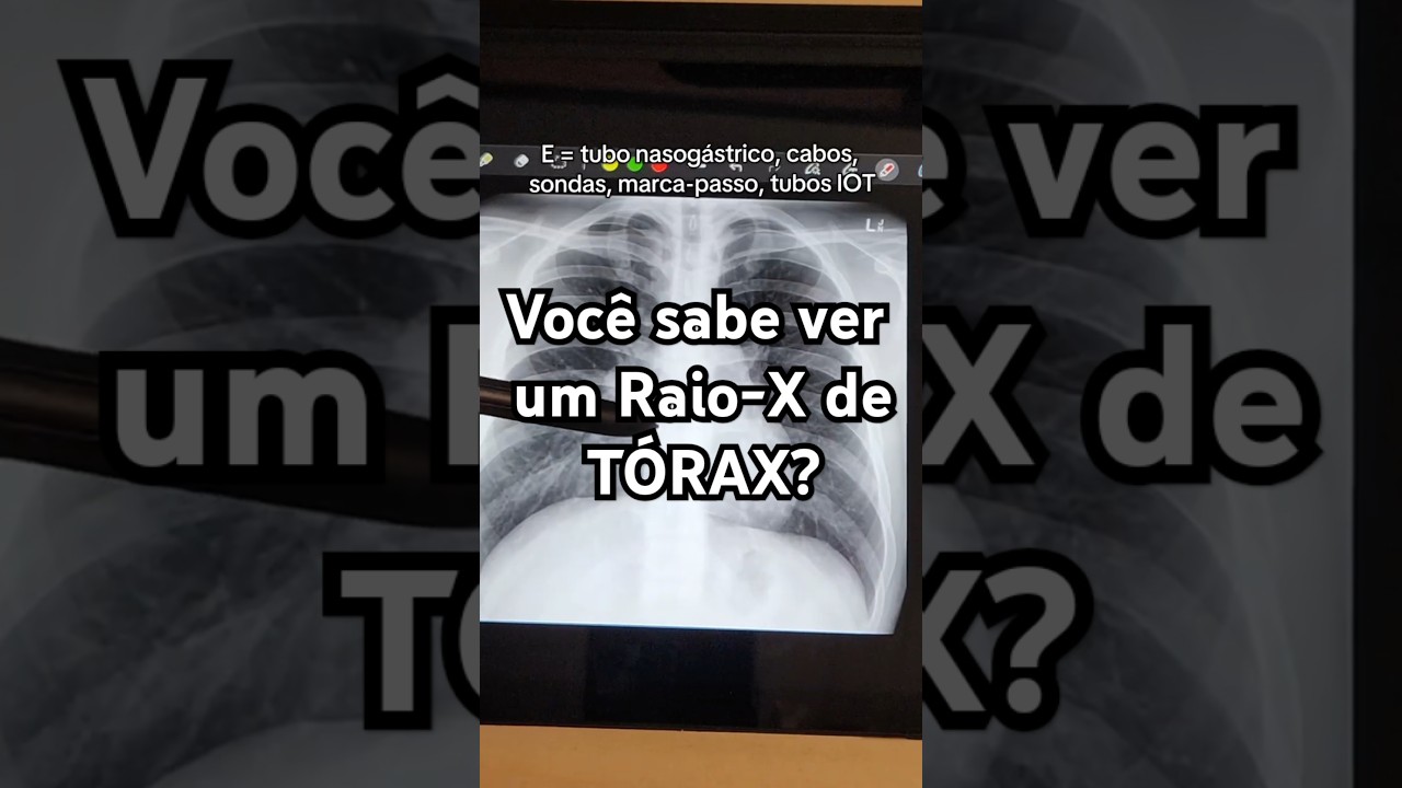 Como aprender a ver Raio X de T&oacute;rax em 2 minutos?