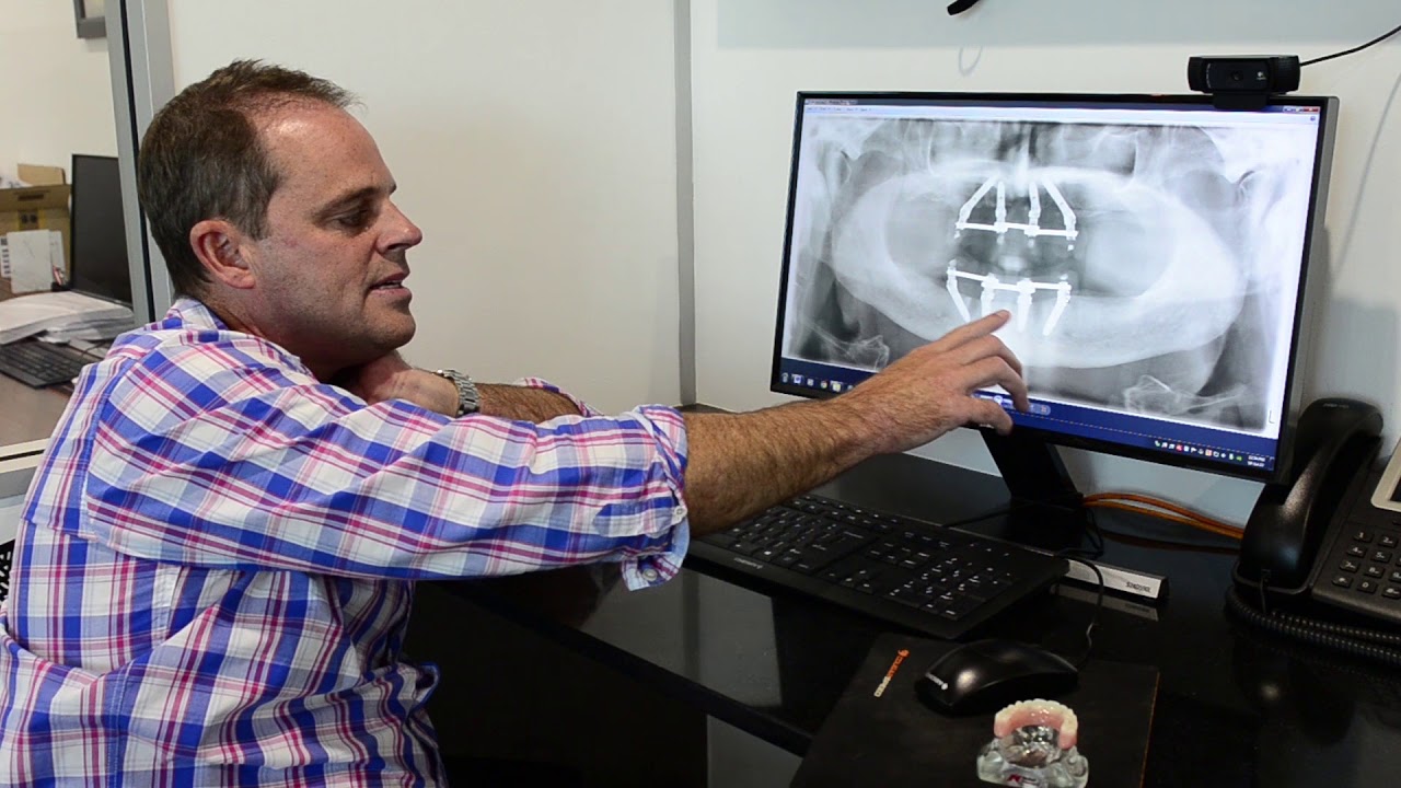 All-on-4 dental implant case study | Dr Michael Sempf