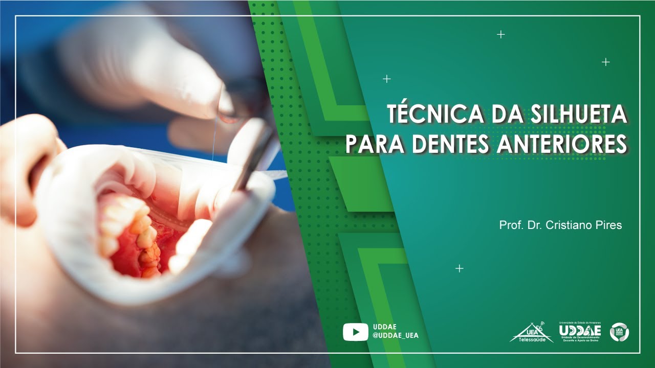 Técnica da Silhueta para Dentes Anteriores -  Vídeo 1