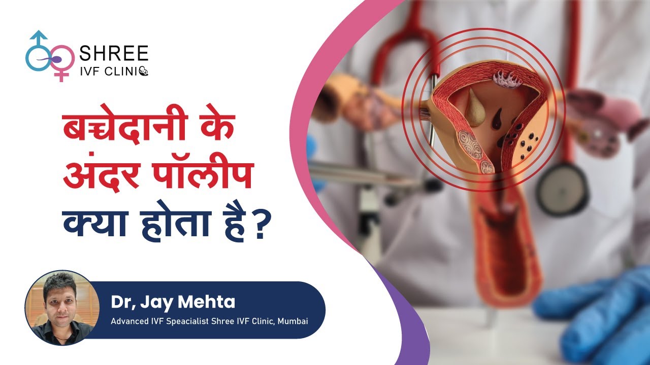 बच्चेदानी के अंदर पॉलीप - क्या होता है ? | Endometrial Polyp In Hindi | Dr Jay Mehta , Shree IVF