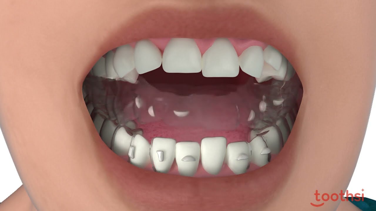 Toothsi Aligner/ Teeth Alignment/ Teeth Straightening / Teeth Gap Treatment