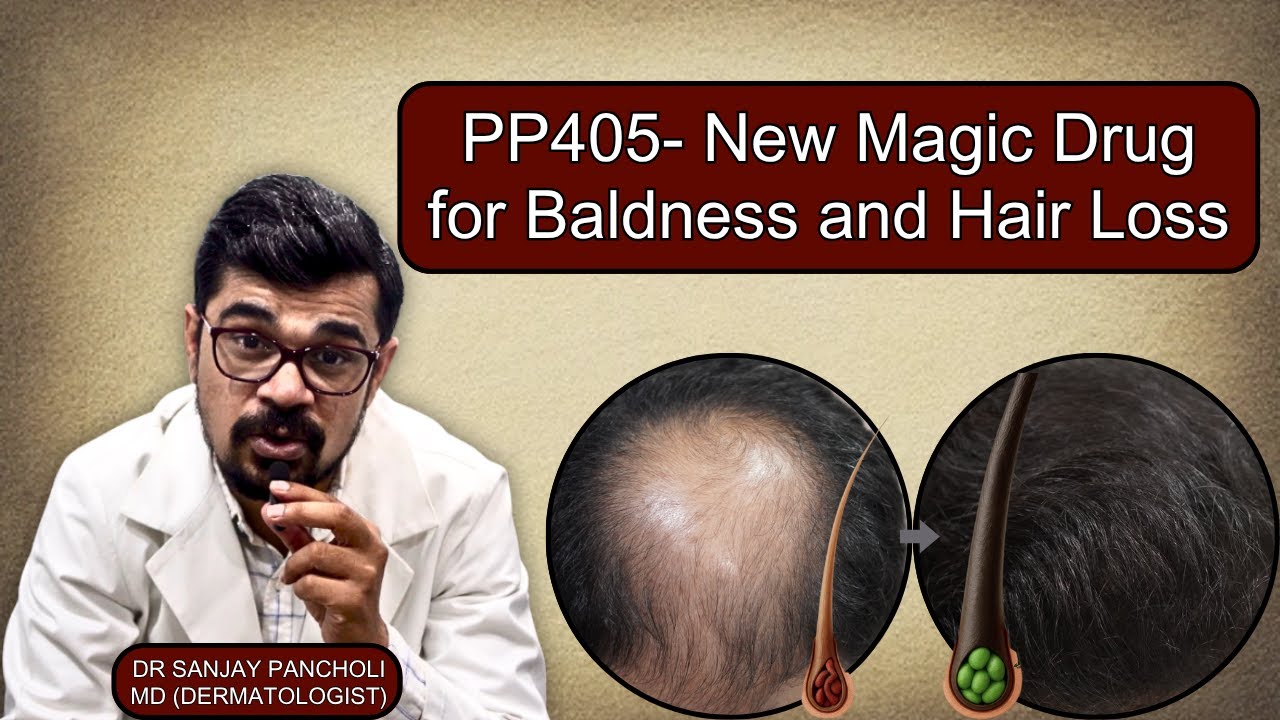 PP405- New Magic Drug for baldness and hair loss #hairtreatment