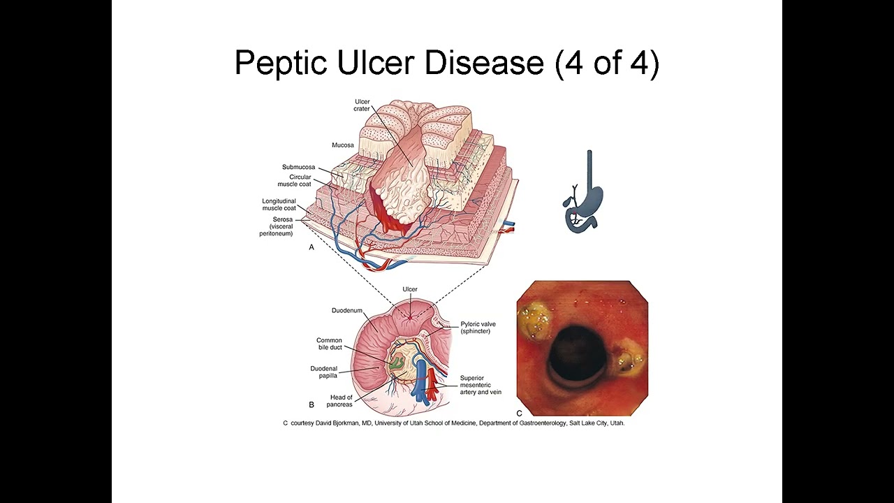 Gastrointestinal Disorders Explained: GERD, Ulcers, IBD, Liver Disease, and Pancreatitis