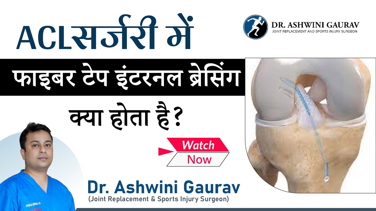 Fiber Tape Internal Bracing In ACL Surgery | ACL Reconstruction In Patna Bihar - Dr Ashwini Gaurav
