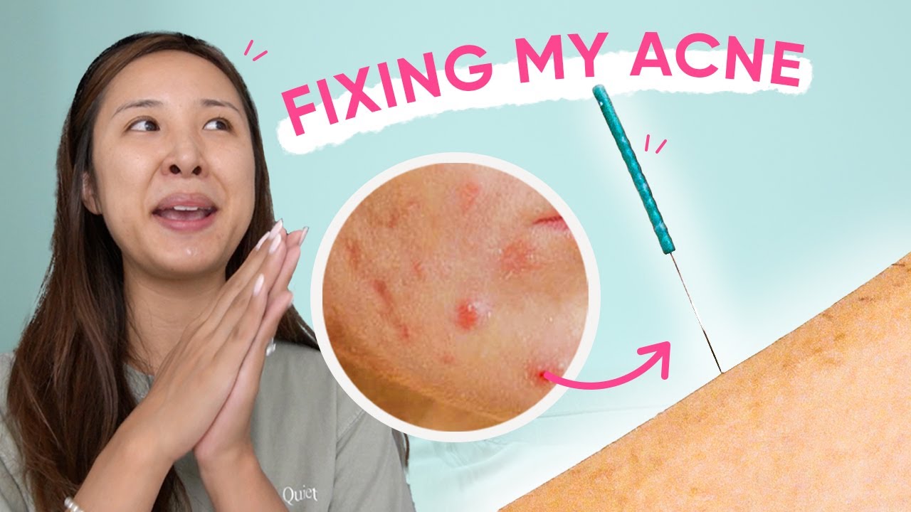 Acupuncture for my ACNE & PMS symptoms 🙈