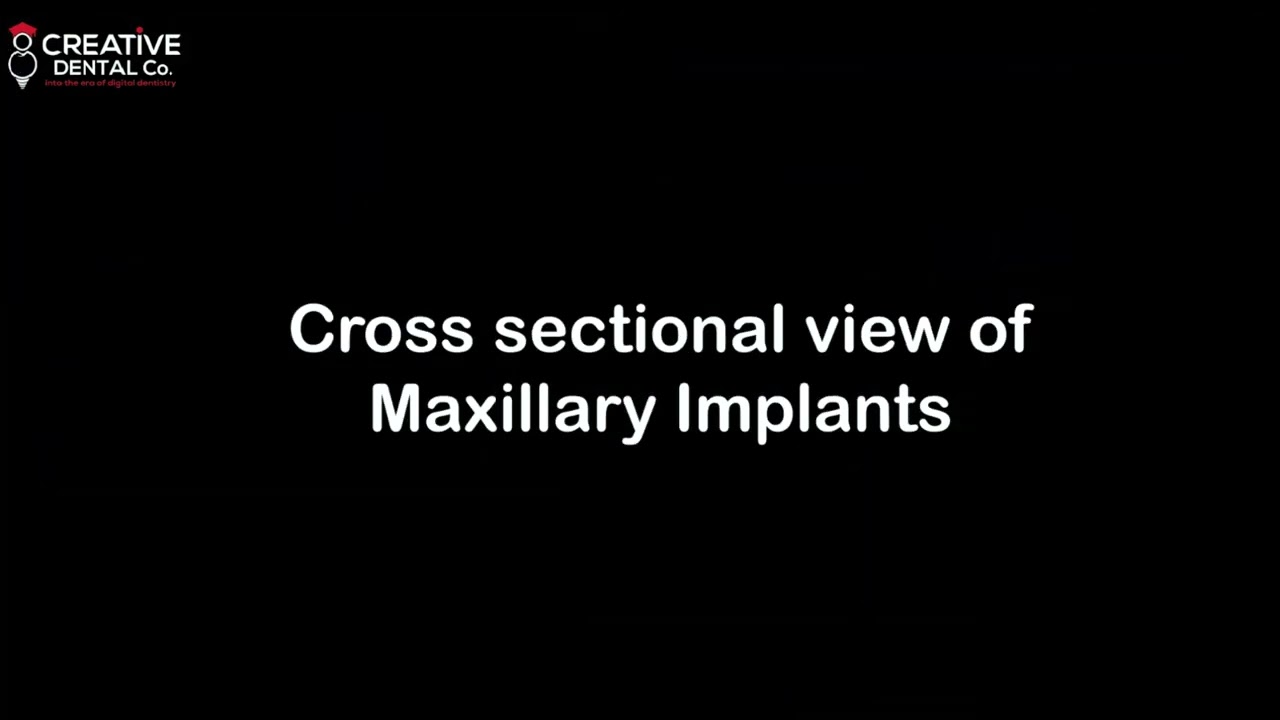 Easy implant in very challenging complicated case. power of it's surface treatment