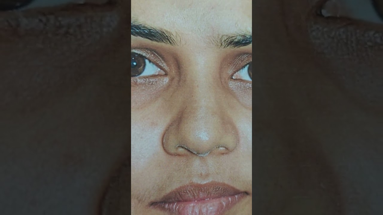 Crooked nose deformity correction Rhinoplasty #drsuniltanvar #dns #rhinoplasty #rhinoplastyexpert 