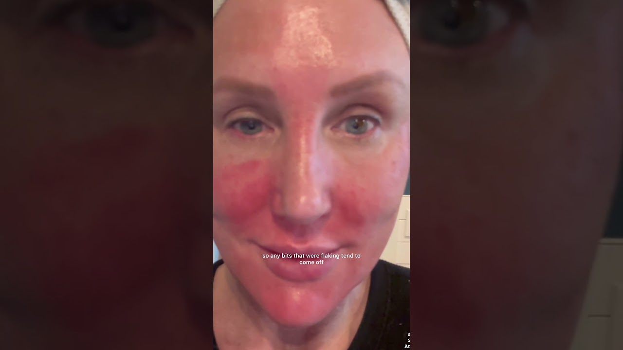 TCA PEEL HEALING DAY 3 
