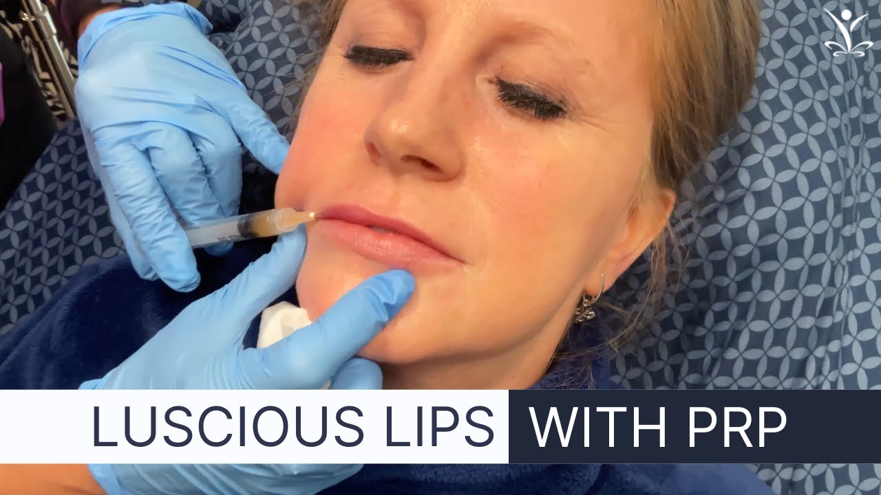 PRP for Natural Lip Injections
