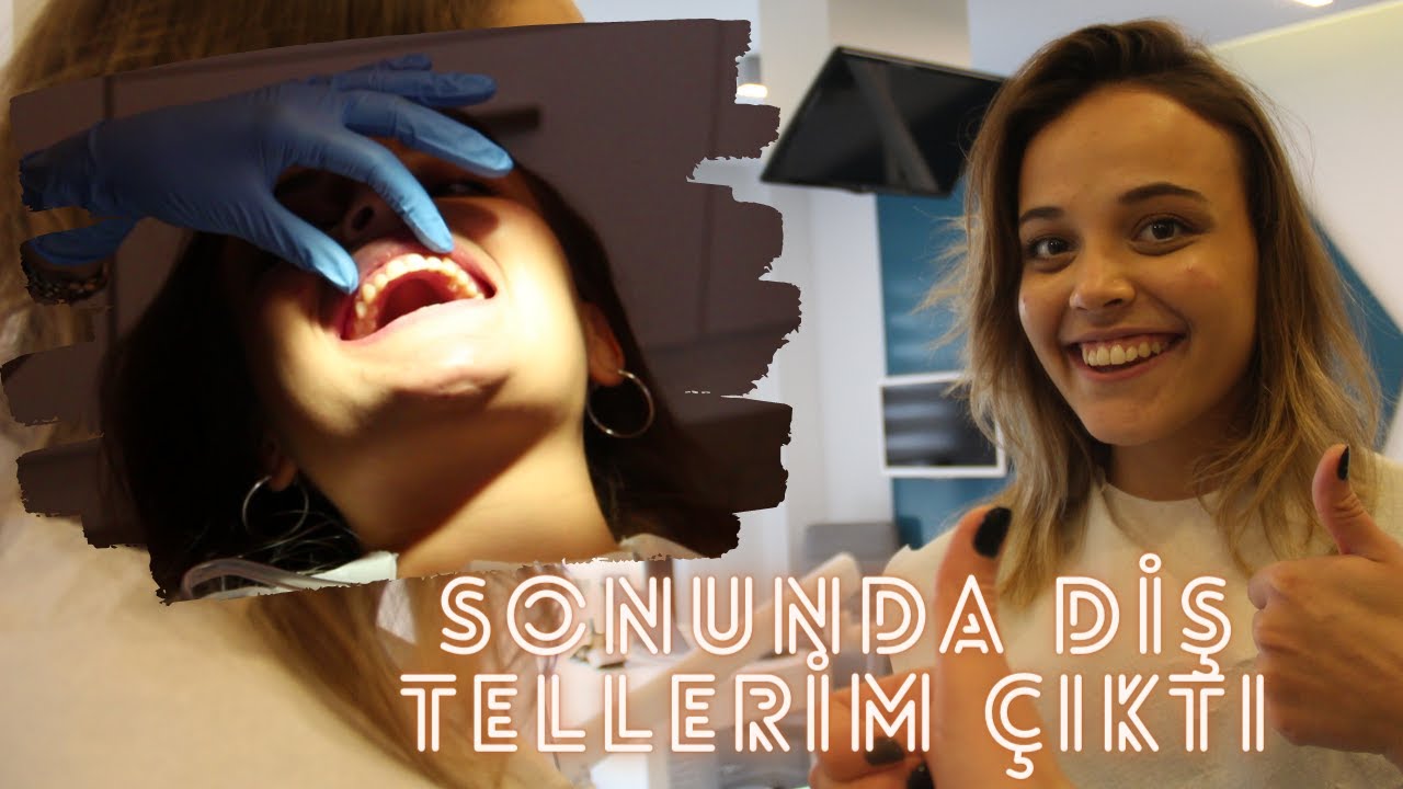 SONUNDA DİŞ TELLERİM ÇIKTI! 🦷 BÖYLE OLMASINI BEKLEMİYORDUM 😲