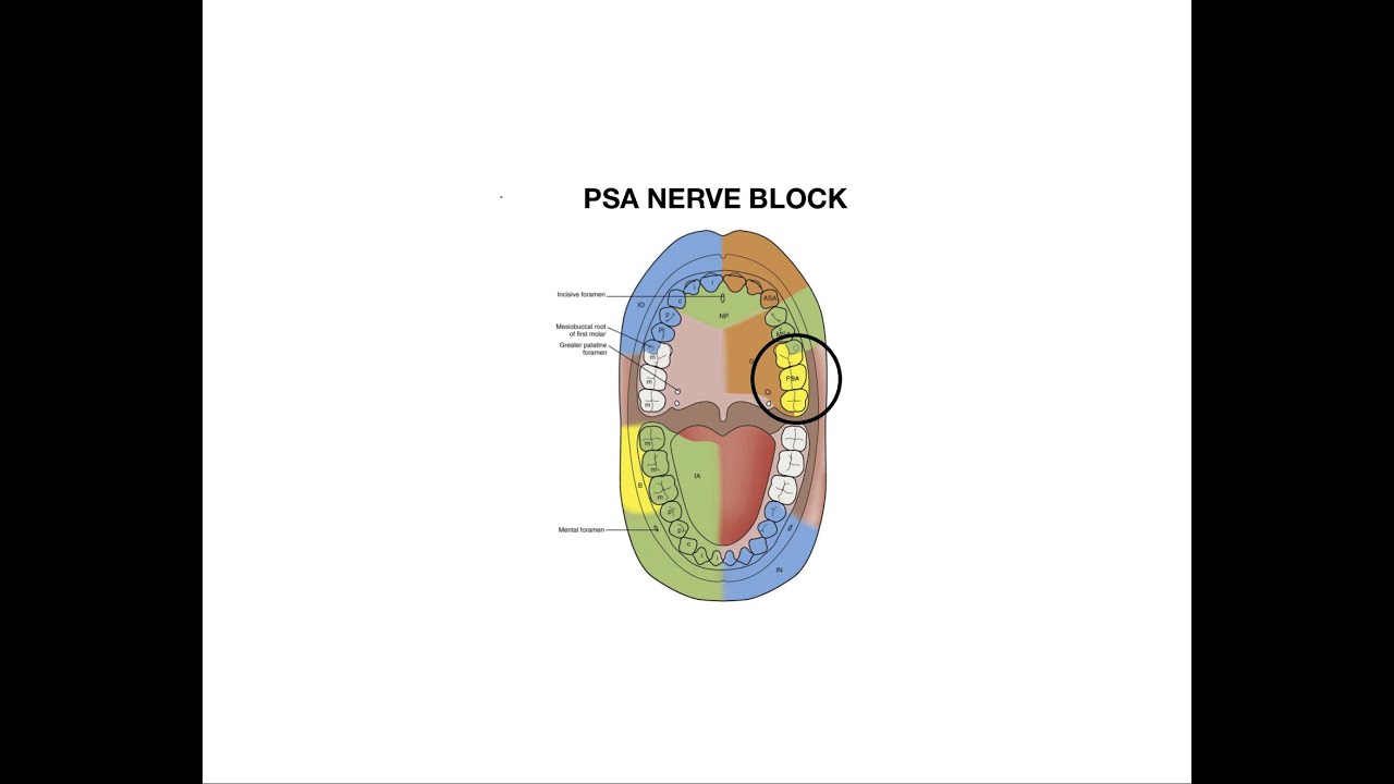 Posterior Superior Alveolar Nerve Block Injection