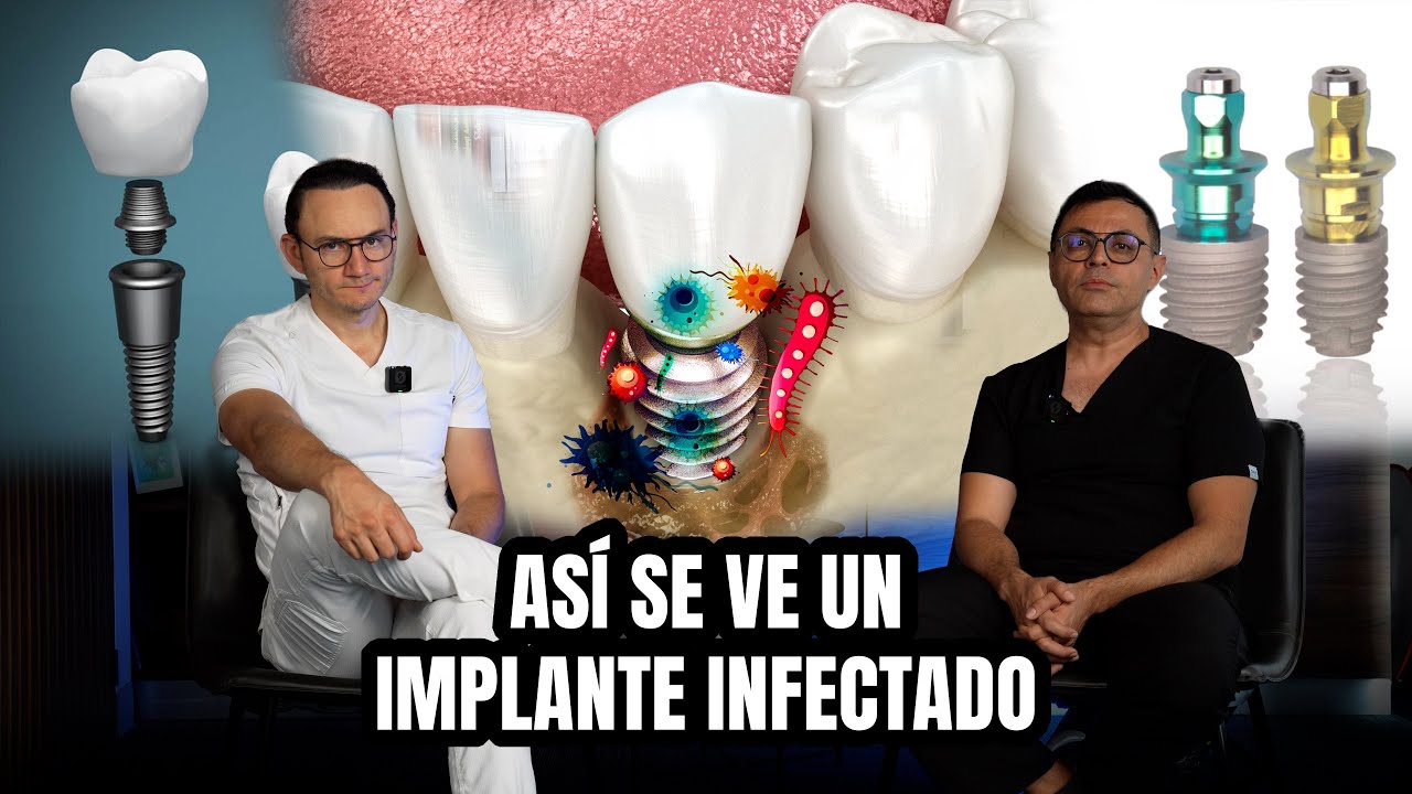 &iquest;C&oacute;mo saber si tu implante dental est&aacute; fracasando?