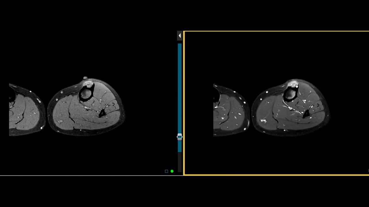 Juxtacortical bone lesion in tibia