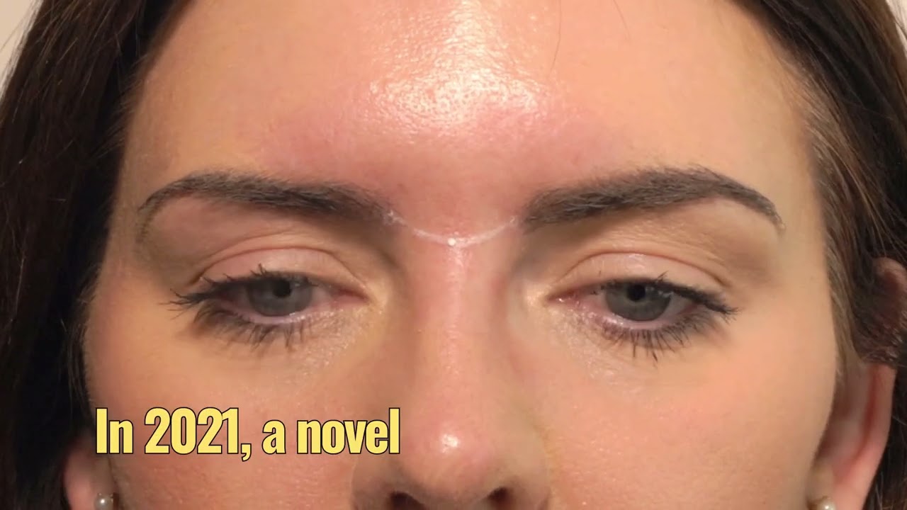 How-To Treat The Glabella With Botox - 3 Point Injecting Technique | Dr Chris Hutton