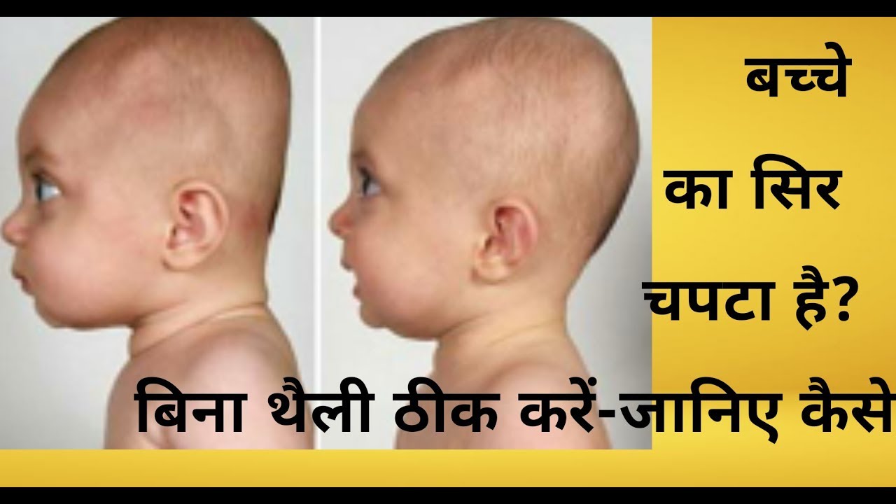 कैसे पता करें कि कहीं बच्चे का सिर चपटा तो नहीं हो गया -क्या करें(cure flat head in babies)