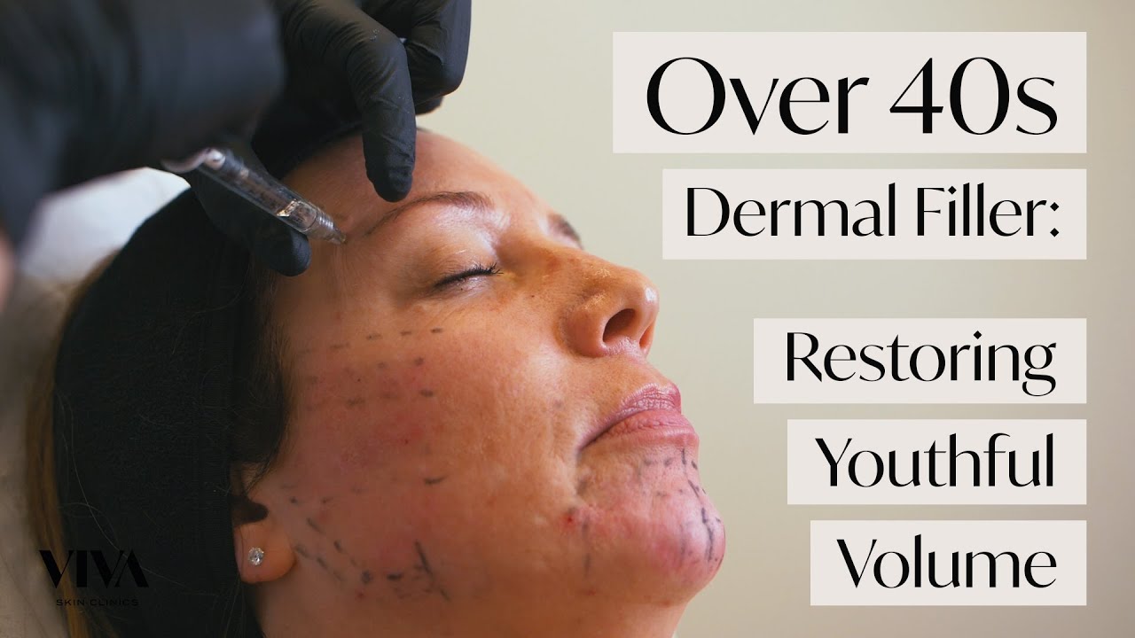 Dermal Filler for Over 40s 💆‍♀️ Restoring Youthful Volume