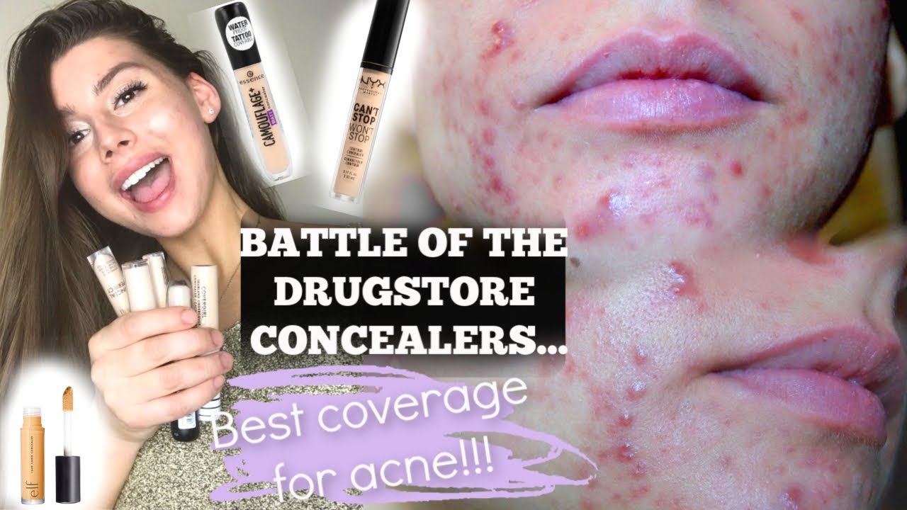 THE BEST ACNE COVERAGE CONCEALER IN THE DRUGSTORE, the winner is... || NYX, Elf, Essence, Covergirl