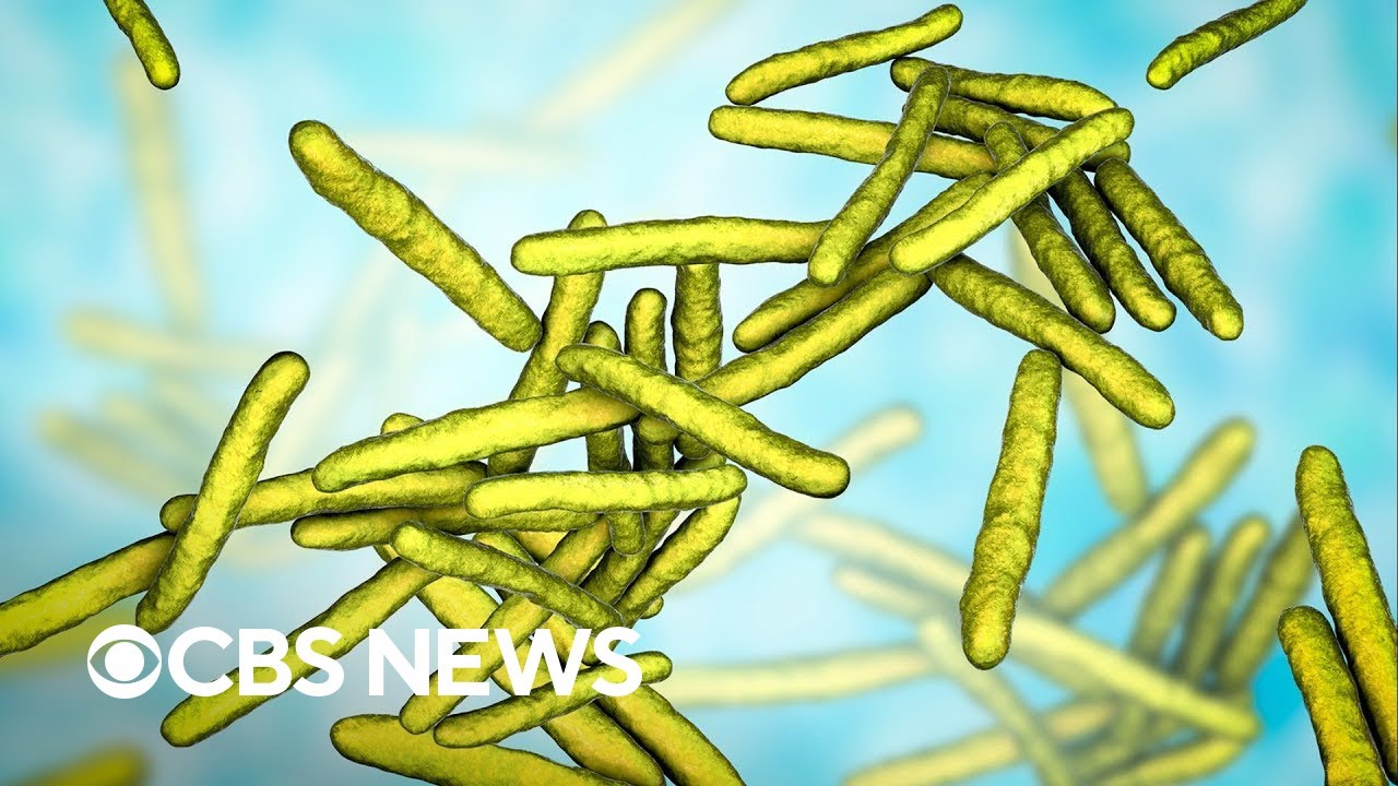 Florida becomes hotspot for leprosy, CDC says