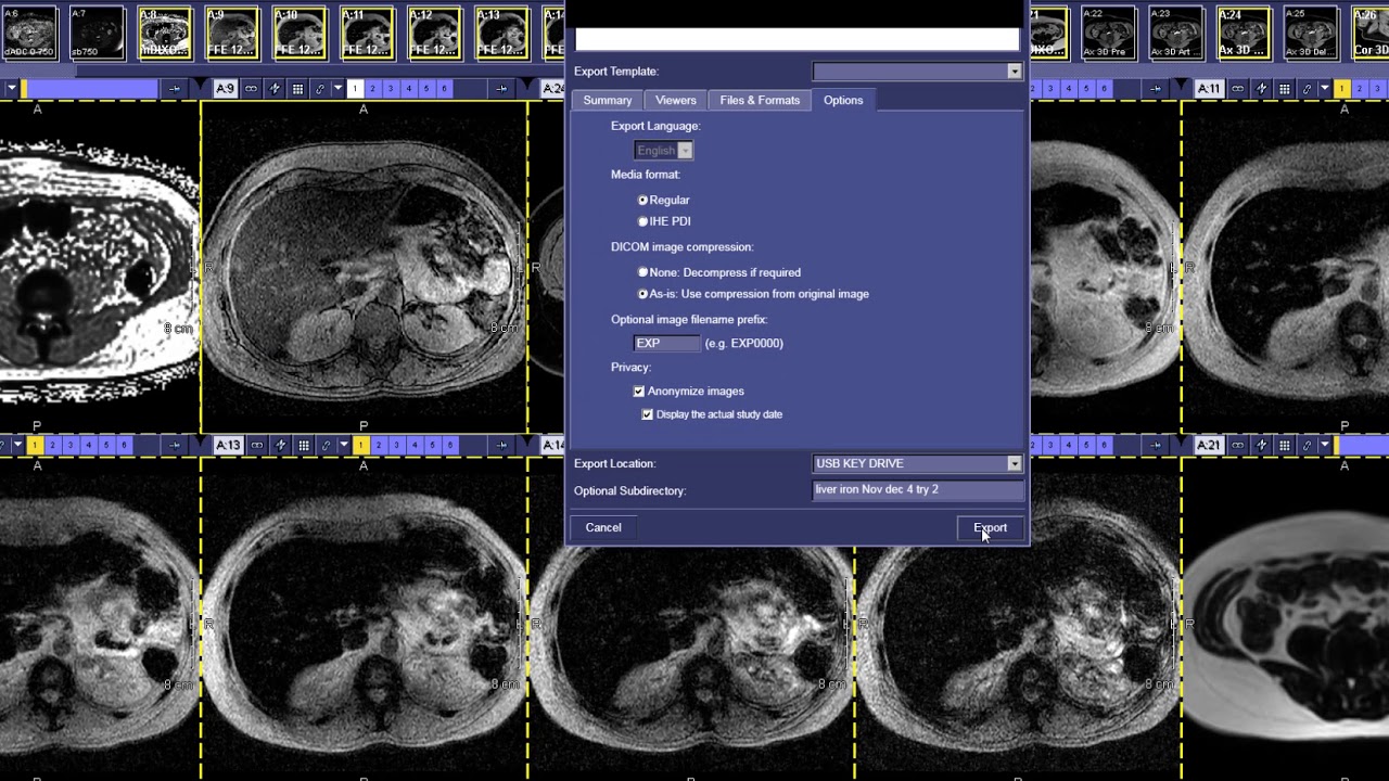 How to read a Iron Quantification MRI