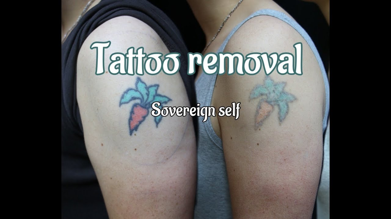 Tattoo removal- 432hz Subliminal Audible affirmations