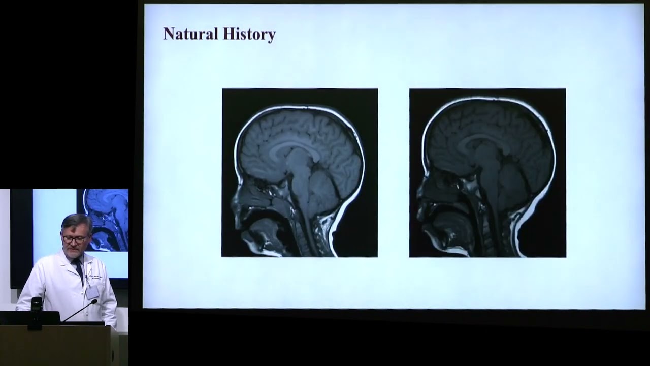 Long Term Health with Chiari Malformation - Dr. Cormac Maher