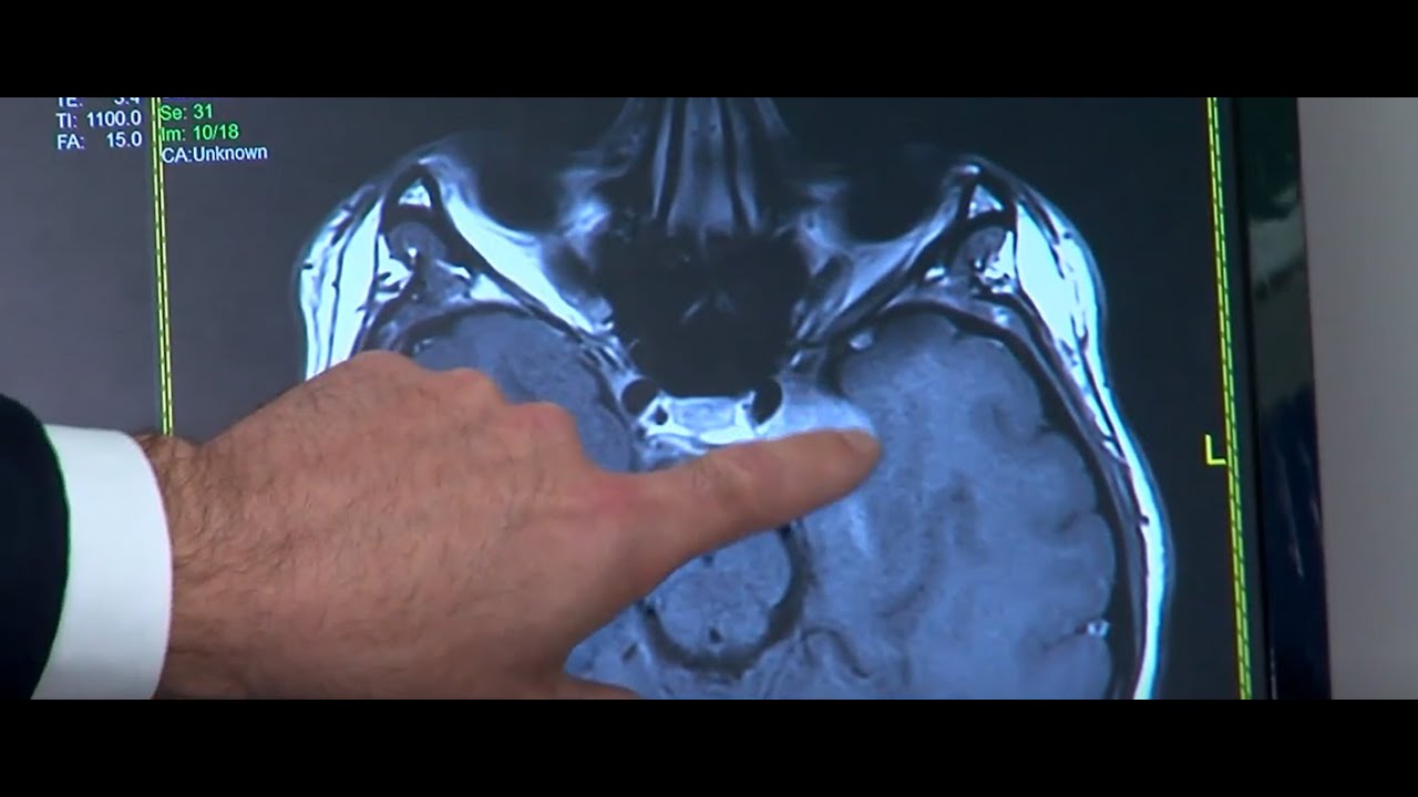 B.E.F.A.S.T.: Signs, symptoms of a stroke during prime stroke season