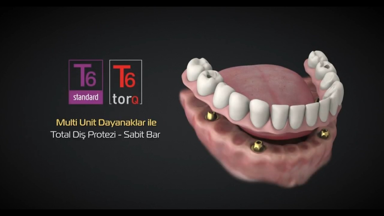 NucleOSS Multi Unit Dayanaklar | Total Diş Protezi - Sabit Bar