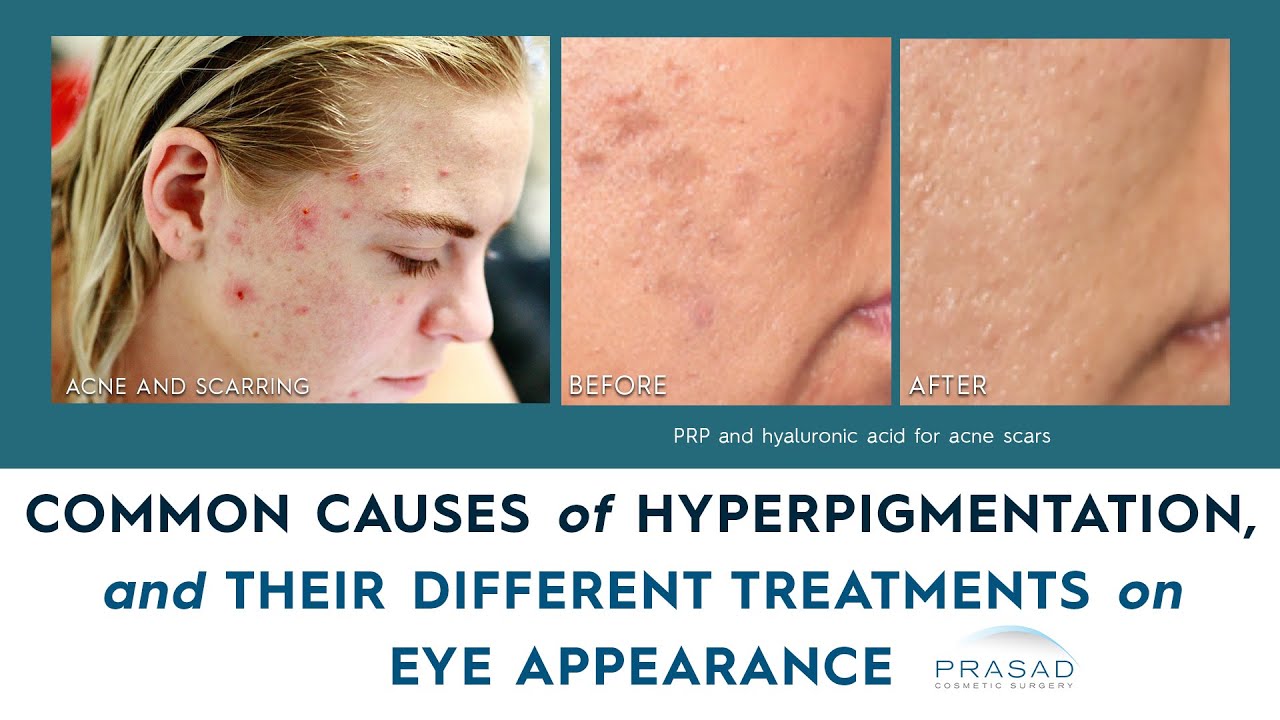 Common Causes of Hyperpigmentation, and How They Can be Treated