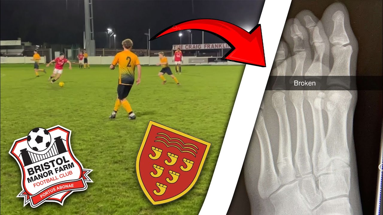 Horrible injury 😳 🦴 Bristol Manor Farm V Keynsham!!! *Broken bone*